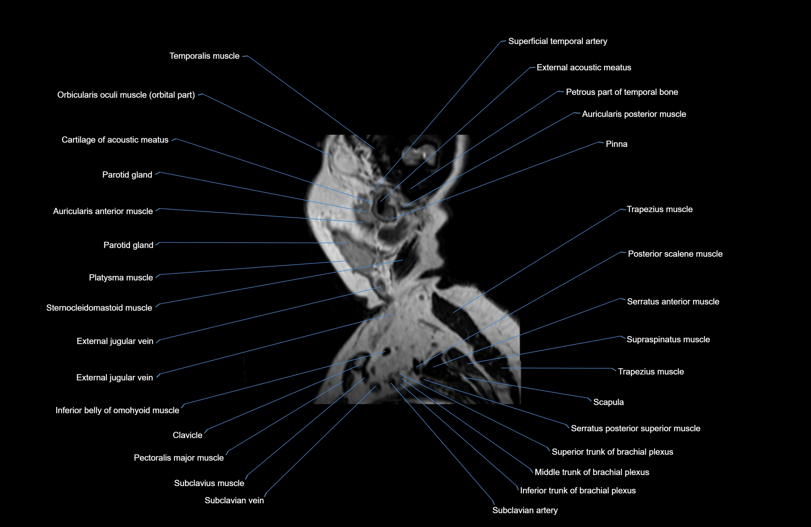 Neck MRI sagittal cross sectional anatomy 3D 1mm 3T radiology  image-img-00001-00039.webp